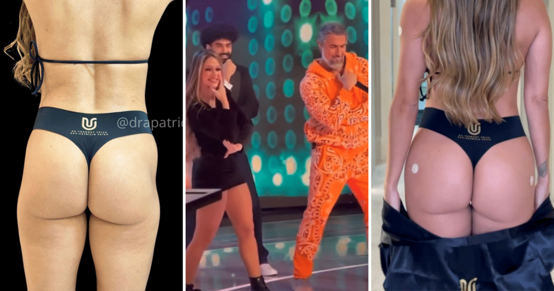 Antes e depois: bailarina do Mion faz harmonização de bumbum no ES (Foto: Foto: Instagram/@drapatriciafrico)